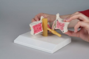 Skriemelis - osteoporoze